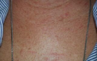 Scratches that appeared on Belinda’s chest